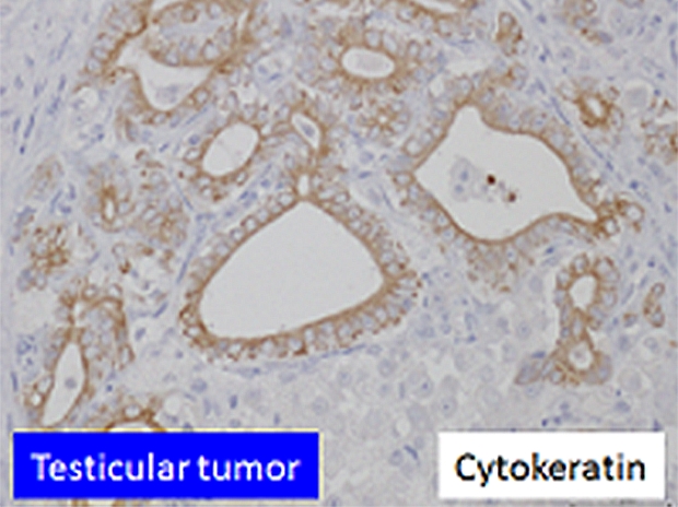 Testicular tumor イメージ02